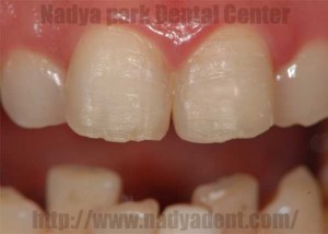 審美歯科 Tooth Wear 酸蝕症 名古屋 症例 審美歯科 Tooth Wear 酸蝕症 名古屋 症例