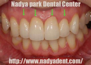 審美歯科 セラミック治療 名古屋 症例 審美歯科 セラミック治療 名古屋 症例