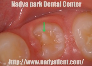 予防歯科　中心結節　名古屋　症例