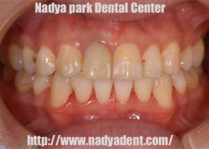 審美歯科　ホワイトニング　矯正歯科　セラミック治療　名古屋　症例