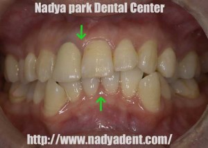 審美歯科　ホワイトニング　矯正歯科　セラミック治療　名古屋　症例