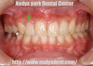 審美歯科　矯正歯科　オールセラミック治療　名古屋　症例