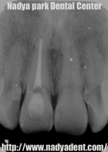 審美歯科　予防歯科　小児歯科　名古屋　症例
