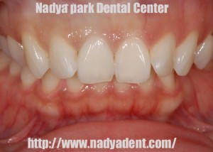 審美歯科　予防歯科　小児歯科　名古屋　症例