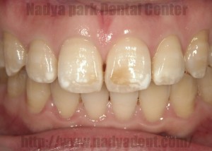 審美歯科　フルベニア　名古屋　症例
