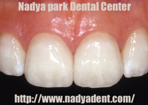 審美歯科　フルベニア　名古屋　症例