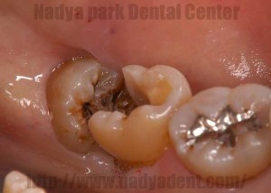 審美歯科　口腔外科　歯牙移植　名古屋　症例