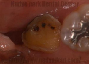 審美歯科　口腔外科　歯牙移植　名古屋　症例