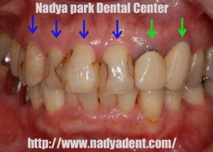 審美歯科　セラミック　名古屋　症例