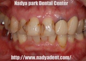 審美歯科　セラミック　名古屋　症例