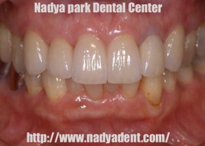 審美歯科　セラミック　名古屋　症例