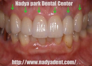 審美歯科　セラミック　名古屋　症例