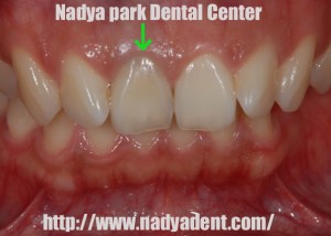 審美歯科　予防歯科　小児歯科　名古屋　症例