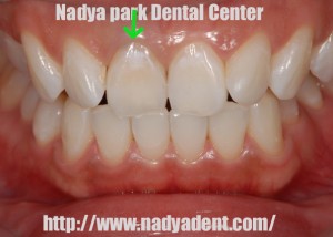 審美歯科　予防歯科　小児歯科　名古屋　症例