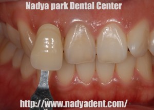 審美歯科　予防歯科　小児歯科　名古屋　症例