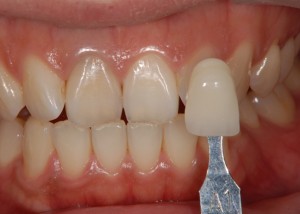 審美歯科　予防歯科　小児歯科　名古屋　症例