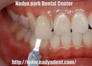 審美歯科　予防歯科　小児歯科　名古屋　症例