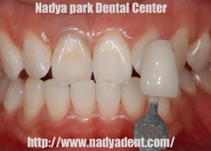 審美歯科　予防歯科　小児歯科　名古屋　症例