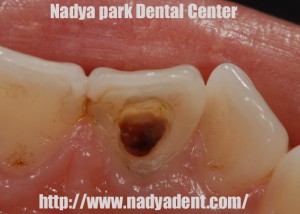 審美歯科　予防歯科　小児歯科　名古屋　症例