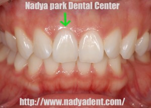 審美歯科　予防歯科　小児歯科　名古屋　症例