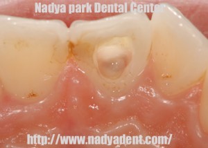 審美歯科　予防歯科　小児歯科　名古屋　症例