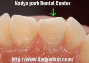 審美歯科　予防歯科　小児歯科　名古屋　症例