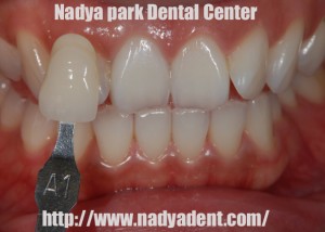 審美歯科　予防歯科　小児歯科　名古屋　症例