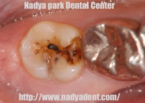 インプラント治療 ー 名古屋 栄 歯科 歯医者